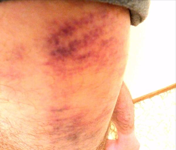 Bruise on leg from gravel impact while sea glass hunting at Davenport Beach